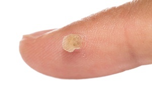 Bradavica - kožna bolest s kojom se učinkovito bori Skincell Pro